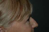 Rhinoplasty