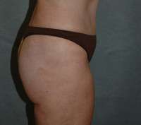 Liposuction