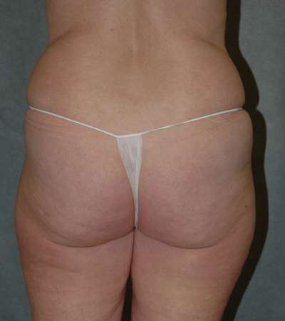 Liposuction