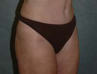 Liposuction