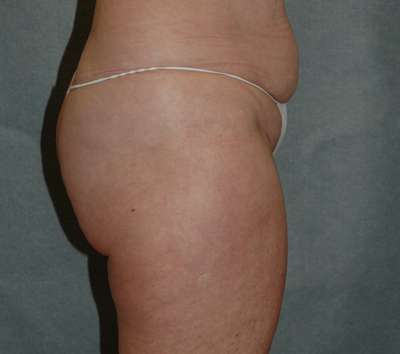 Liposuction