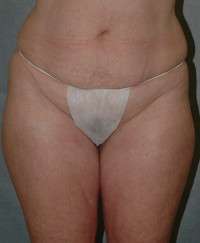 Liposuction