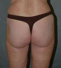 Liposuction