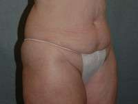 Liposuction