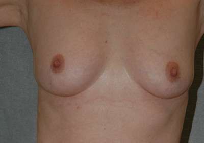 Breast Augmentation