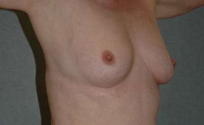 Breast Augmentation