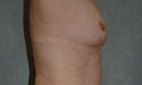 Breast Augmentation