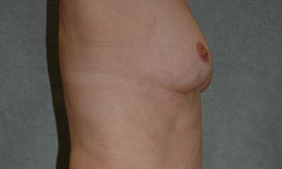 Breast Augmentation