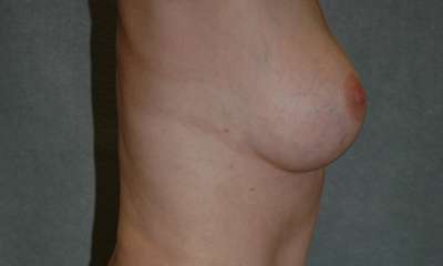 Breast Augmentation