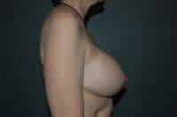 Breast Implant Removal