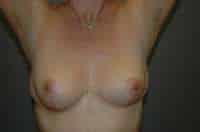 Breast Implant Removal