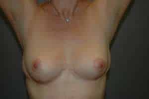 Breast Implant Removal