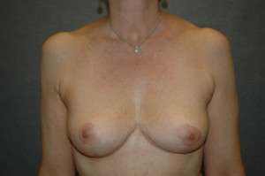 Breast Implant Removal