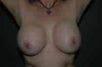 Breast Implant Removal