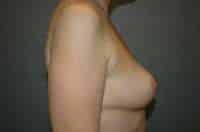 Breast Implant Removal