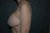 Breast Implant Removal