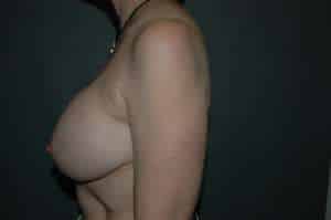 Breast Implant Removal