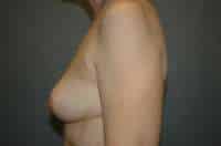 Breast Implant Removal