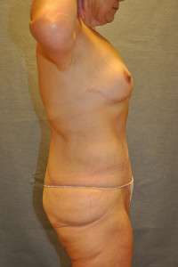 Abdominoplasty