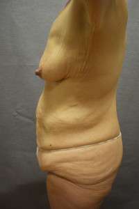 Abdominoplasty