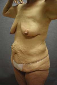 Abdominoplasty