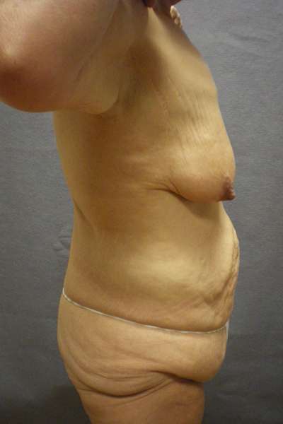 Abdominoplasty