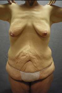 Abdominoplasty