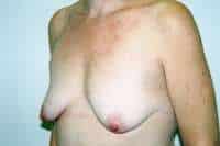 Breast Augmentation with Mastopexy