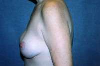 Breast Augmentation with Mastopexy