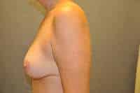 Breast Augmentation with Mastopexy