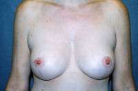 Breast Augmentation with Mastopexy