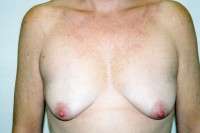 Breast Augmentation with Mastopexy