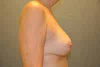 Breast Augmentation with Mastopexy