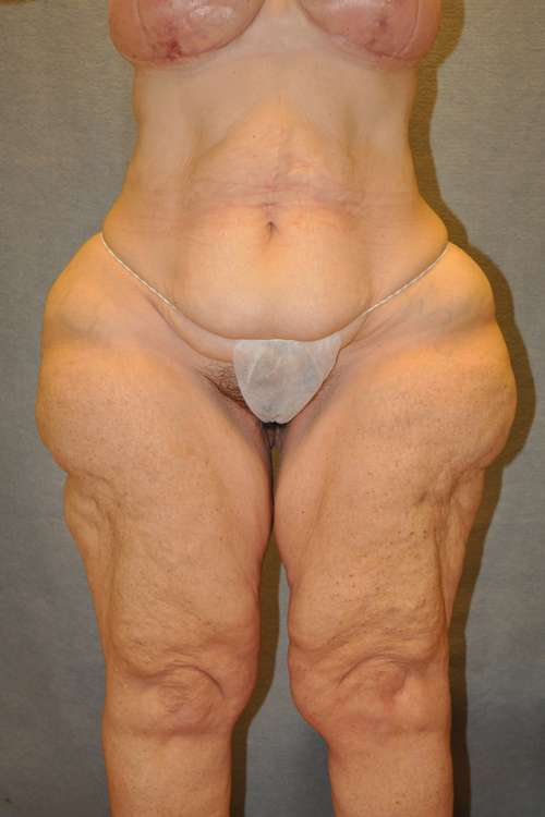 Belt Lipectomy Case 5769 Before Photo Belt Lipectomy
