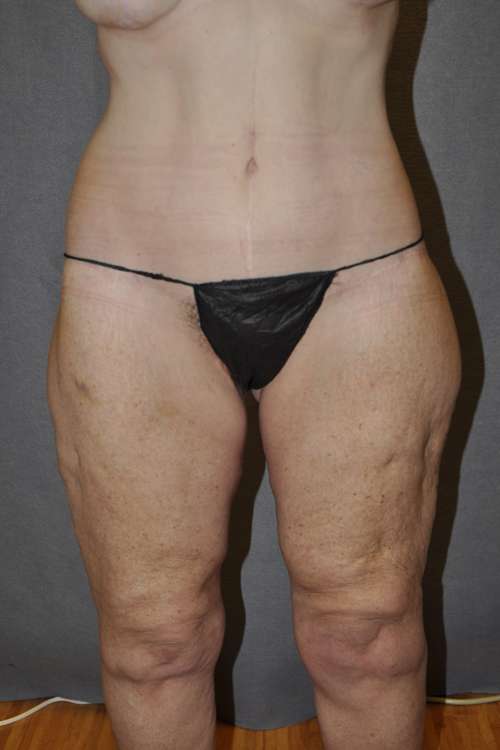 Belt Lipectomy Case 5769 After Photo Belt Lipectomy