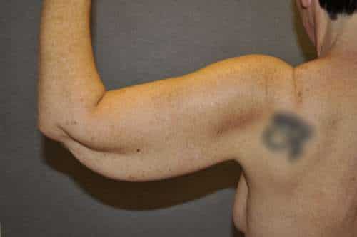 Arm Lift Case 5765 After Photo Arm Lift