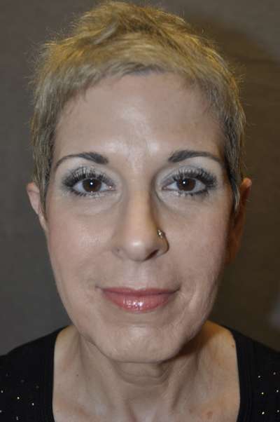 Facelift Case 5772 Before Photo Facelift