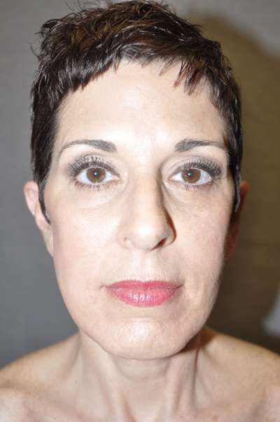 Facelift Case 5772 After Photo Facelift