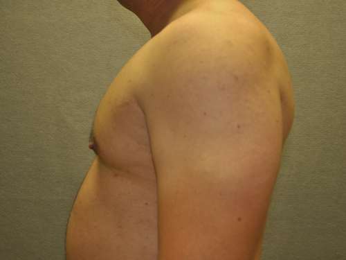 Gynecomastia