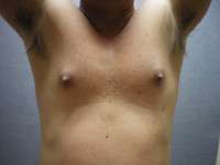 Gynecomastia