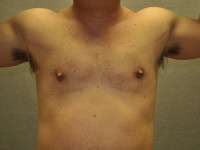 Gynecomastia