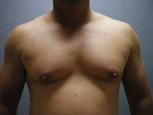 Gynecomastia