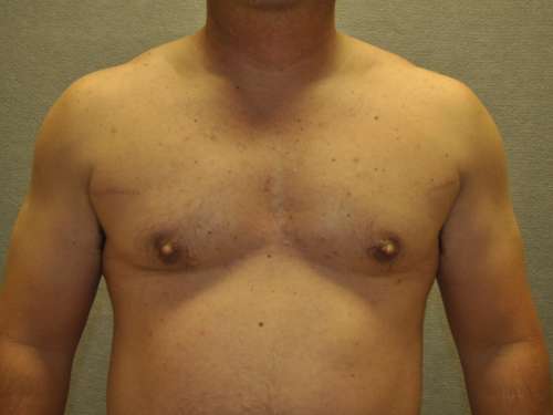 Gynecomastia