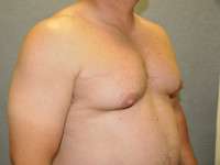 Gynecomastia