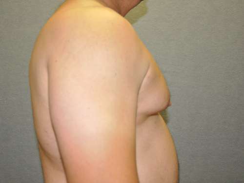 Gynecomastia