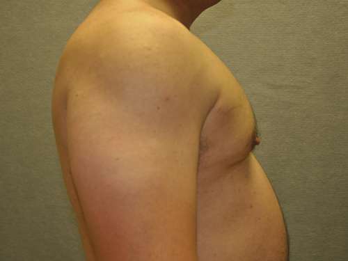 Gynecomastia