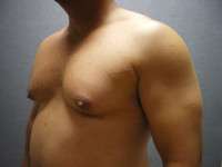 Gynecomastia