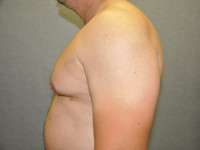 Gynecomastia