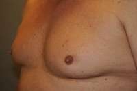 Nipple Reduction