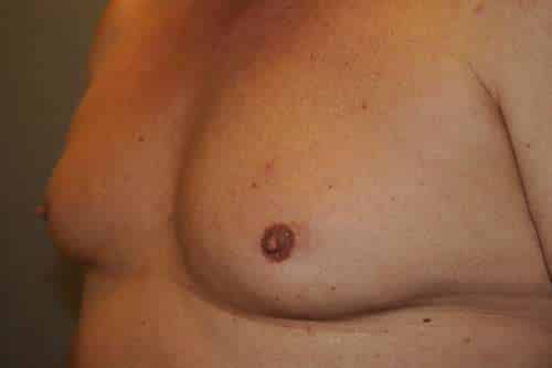 Nipple Reduction